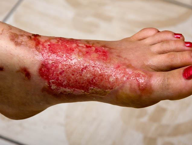 devimed diabetic foot ulcer treatment dressing
